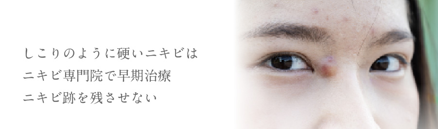 しこりのように固いニキビはニキビ専門院で早期治療ニキビ跡を残させない