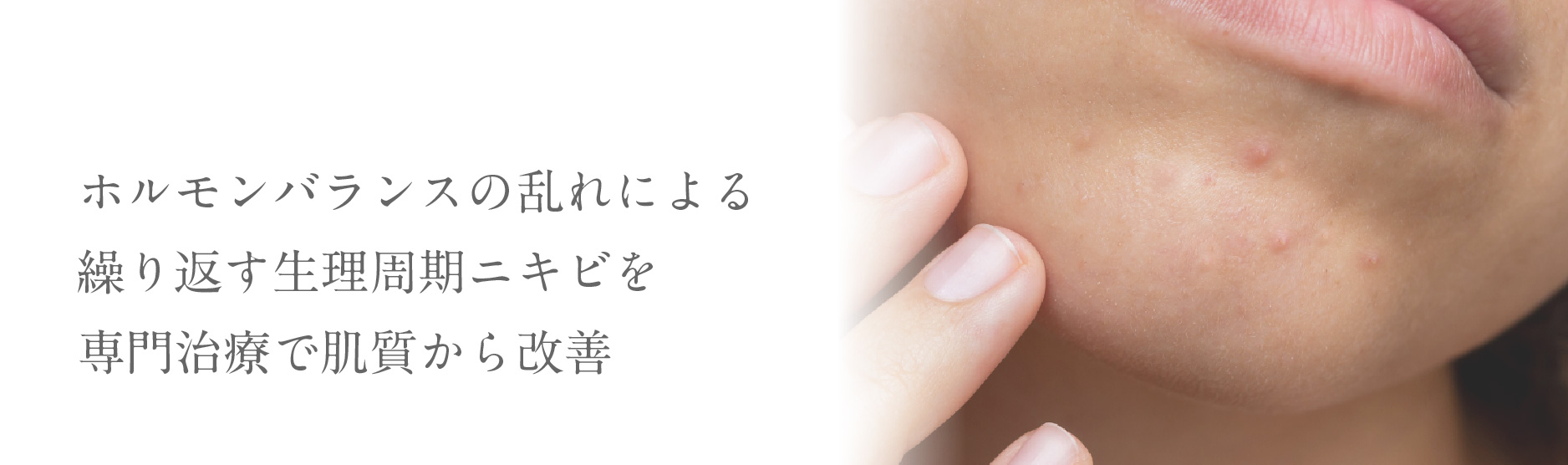 ホルモンバランスの乱れによる繰り返す生理周期ニキビを専門治療で肌質から改善