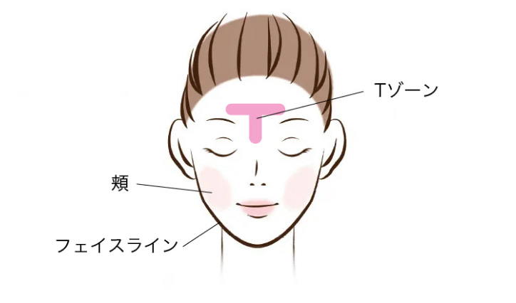 化膿ニキビが発生しやすい場所