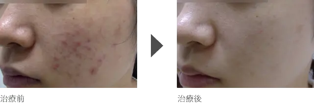頬のニキビ治療 20代女性