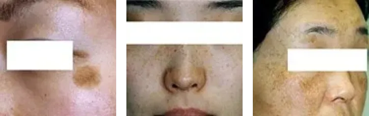 頬にできるシミとは？