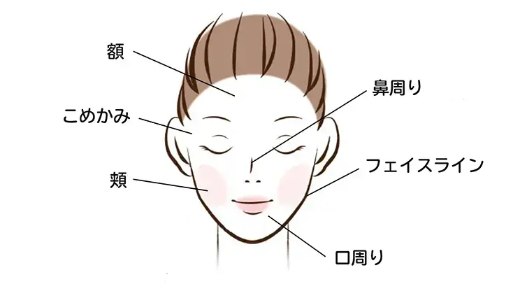混合肌のニキビが発生しやすい場所