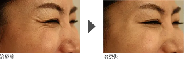 目尻2