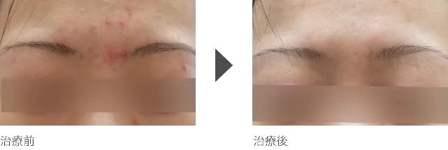 眉間のニキビ治療 20代女性