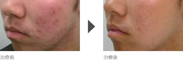 フェイスラインのニキビ治療 10代男性