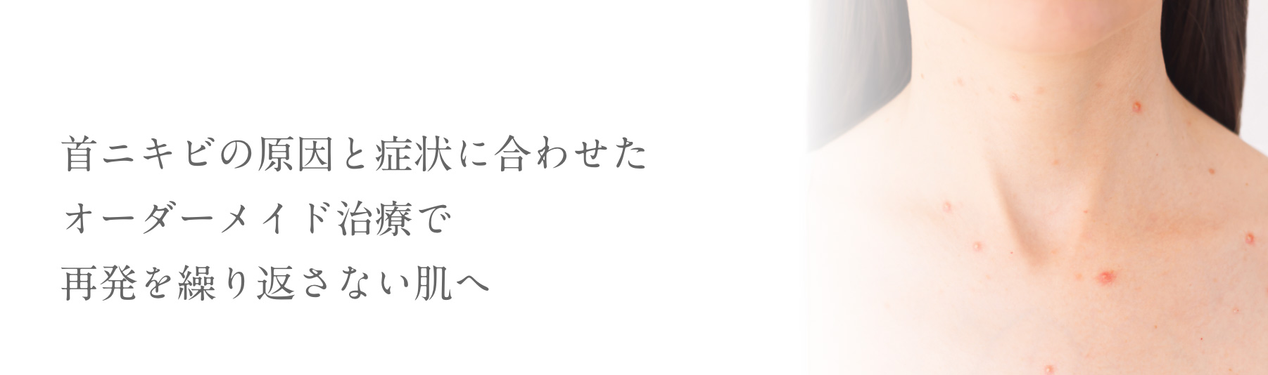 首ニキビの原因と症状に合わせたオーダーメイド治療で再発を繰り返さない肌へ