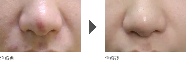 フェイスラインのニキビ治療 20代女性