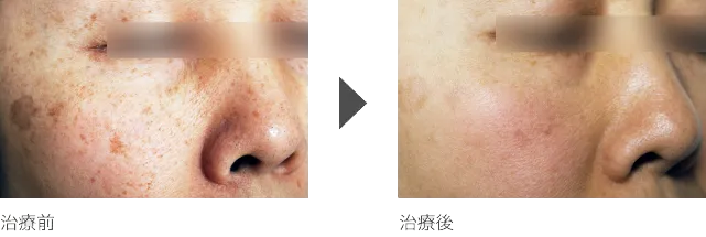 鼻のシミ治療 40代女性