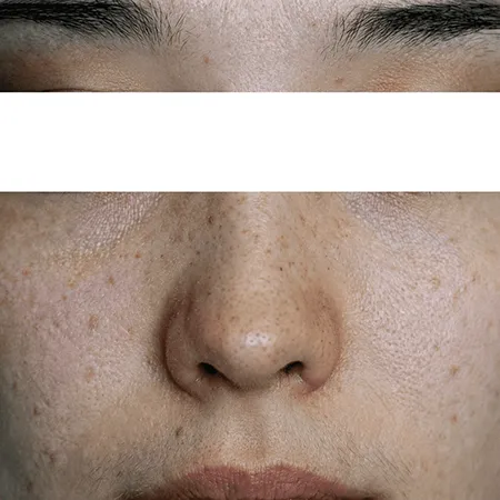 鼻にできるシミとは？