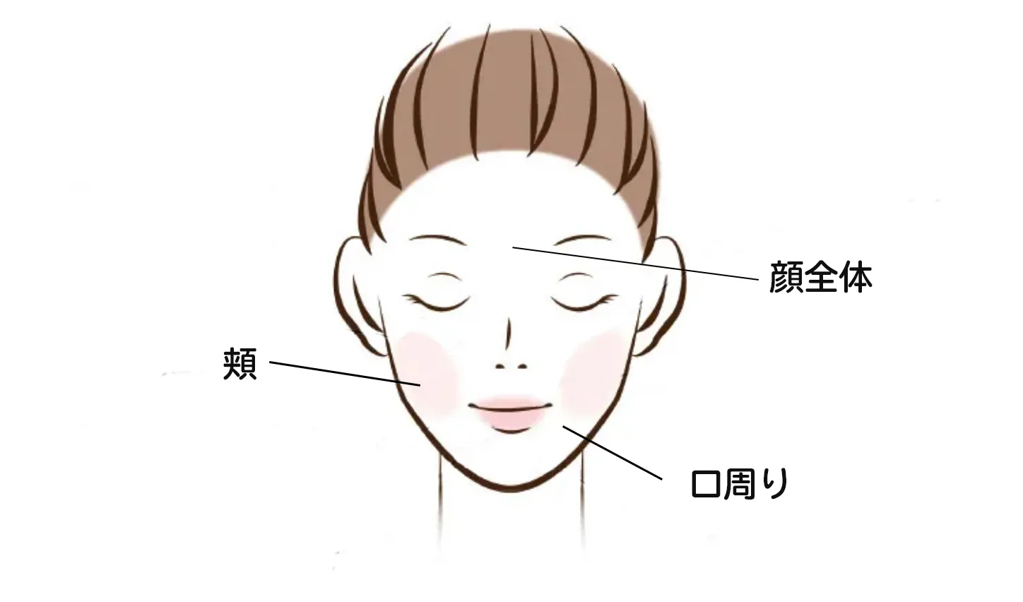 敏感肌のニキビが発生しやすい場所