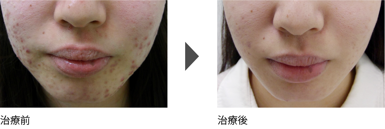 頬、顎（あご）周りのニキビ治療 20代後半女性