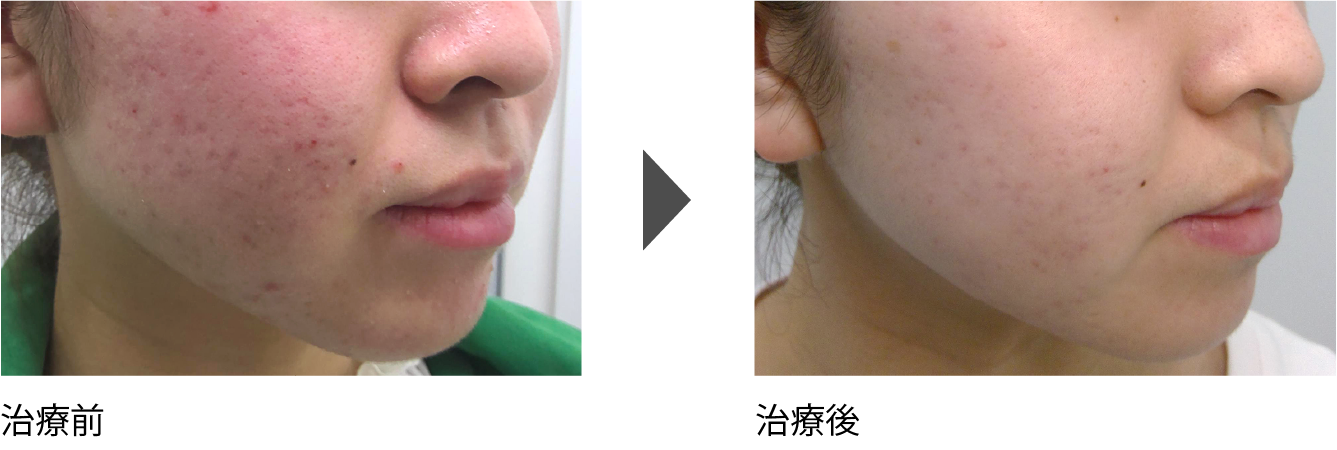 頬、顎（あご）周りのニキビ治療 20代後半女性