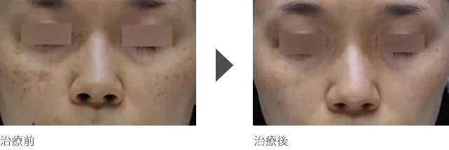 目の下、目元のシミ治療 30代女性