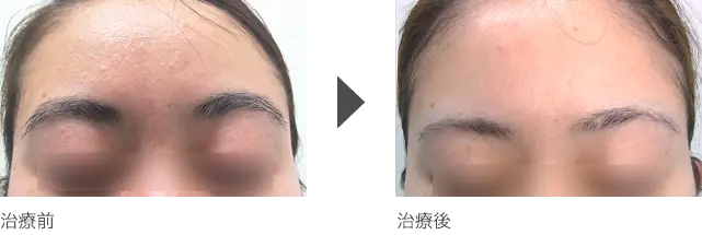 額の白ニキビ治療 10代女性