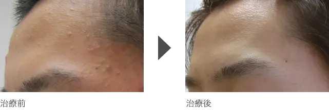 額、こめかみの白ニキビ治療 20代男性