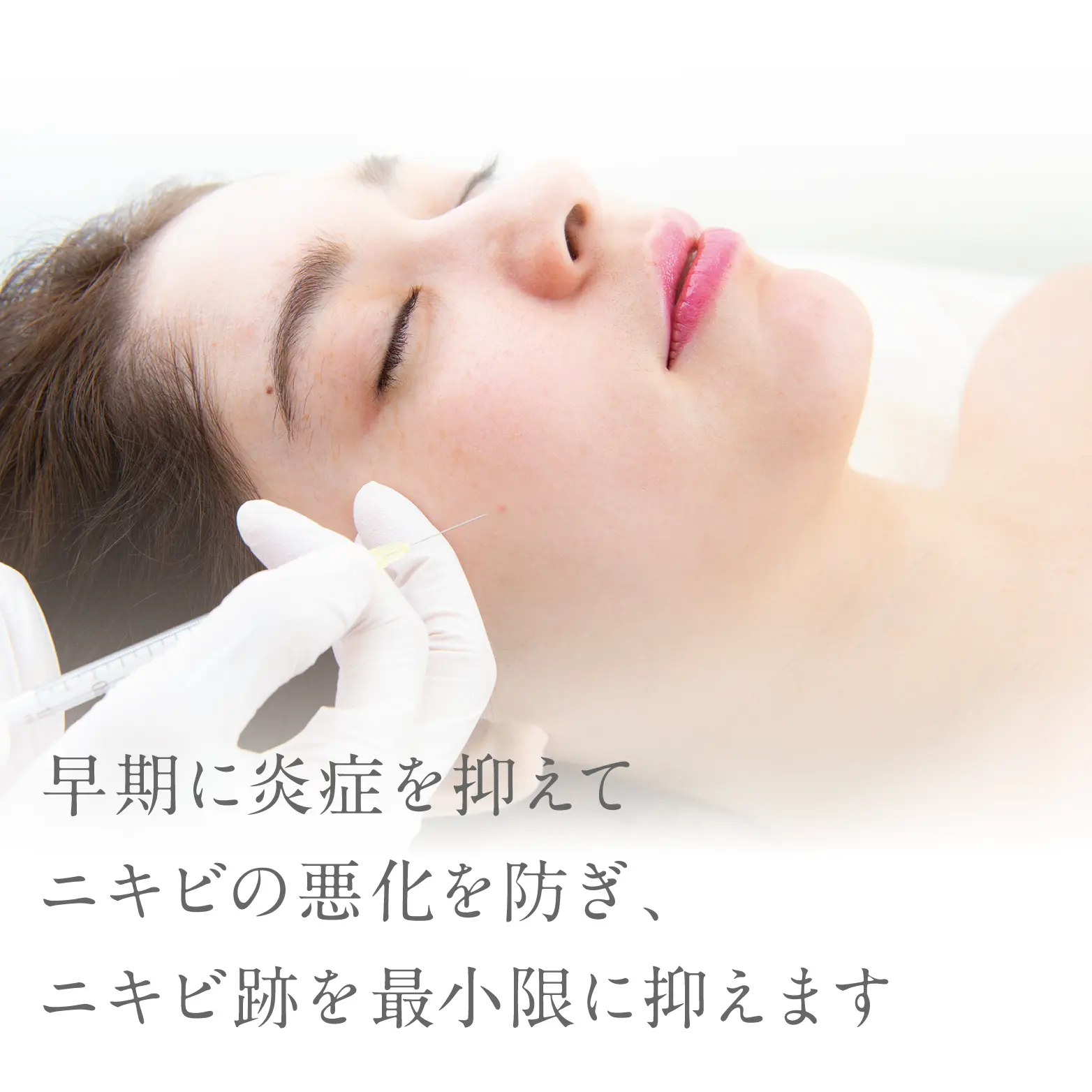 早期に炎症を抑えてニキビの悪化を防ぎ、ニキビ跡を最小限に抑えます