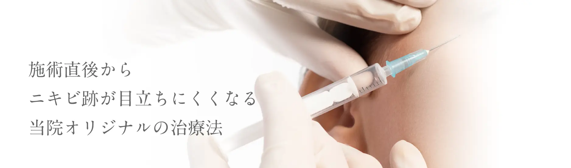 施術直後からニキビ跡が目立ちにくくなる当院オリジナルの治療法