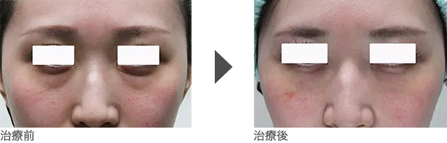 目の下のくま 20代 女性