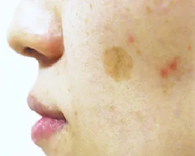 症例(広範囲のシミ・くすみ・そばかすなどでお悩みの方)