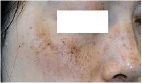 症例(広範囲のシミ・くすみ・そばかすなどでお悩みの方)