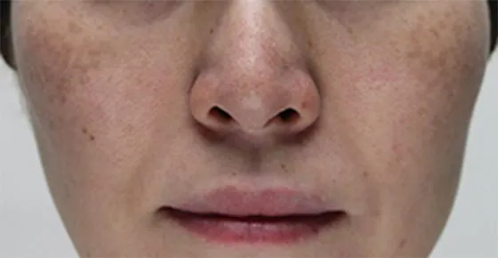 症例(広範囲のシミ・くすみ・そばかすなどでお悩みの方)