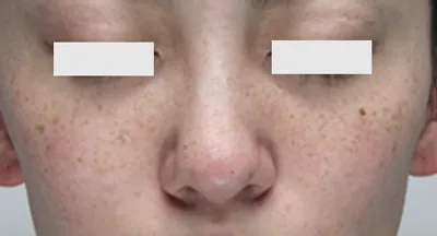 症例(薄いシミでお悩みの方方)