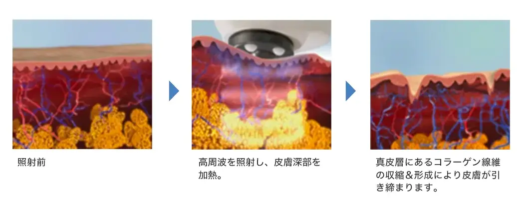 高周波テクノロジー