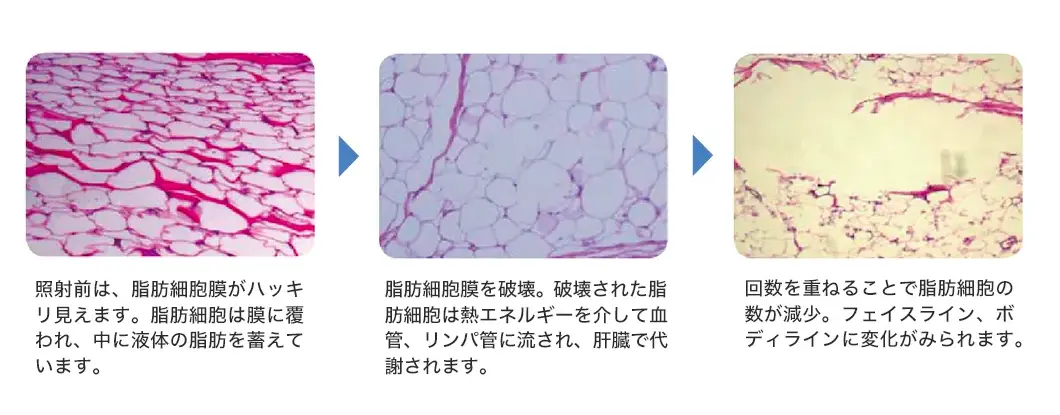 超音波テクノロジー